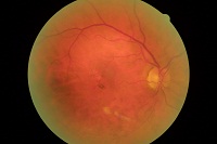 OCT Medoptica